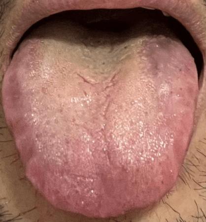 新澳2025资料最新大全和舌根和牙龈被缝一起与舌根和牙龈被缝一起怎么办